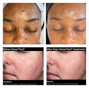 Chemical Peels Photo