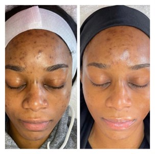 Chemical Peel: PCA Sensi No Peel Photo