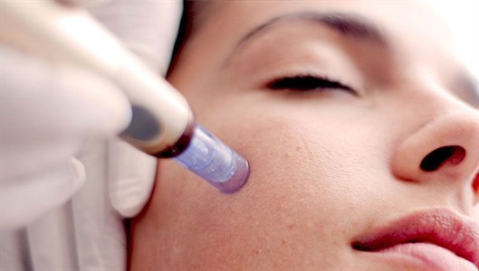 Micro - Needling Photo