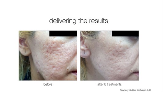 Venus Viva Skin Resurfacing Photo