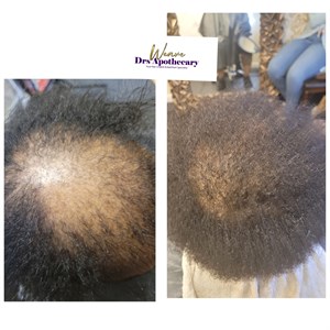 Alopecia Hair Restoration, Prp treatment, Growth factors